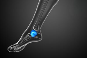 frattura malleolo - SanaMedical centro ortopedico e fisioterapico