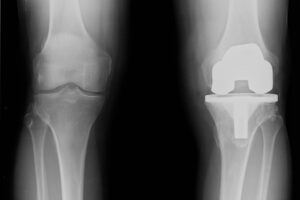 Come funziona la protesi di ginocchio - SanaMedical Centro Ortopedico e Fisioterapico